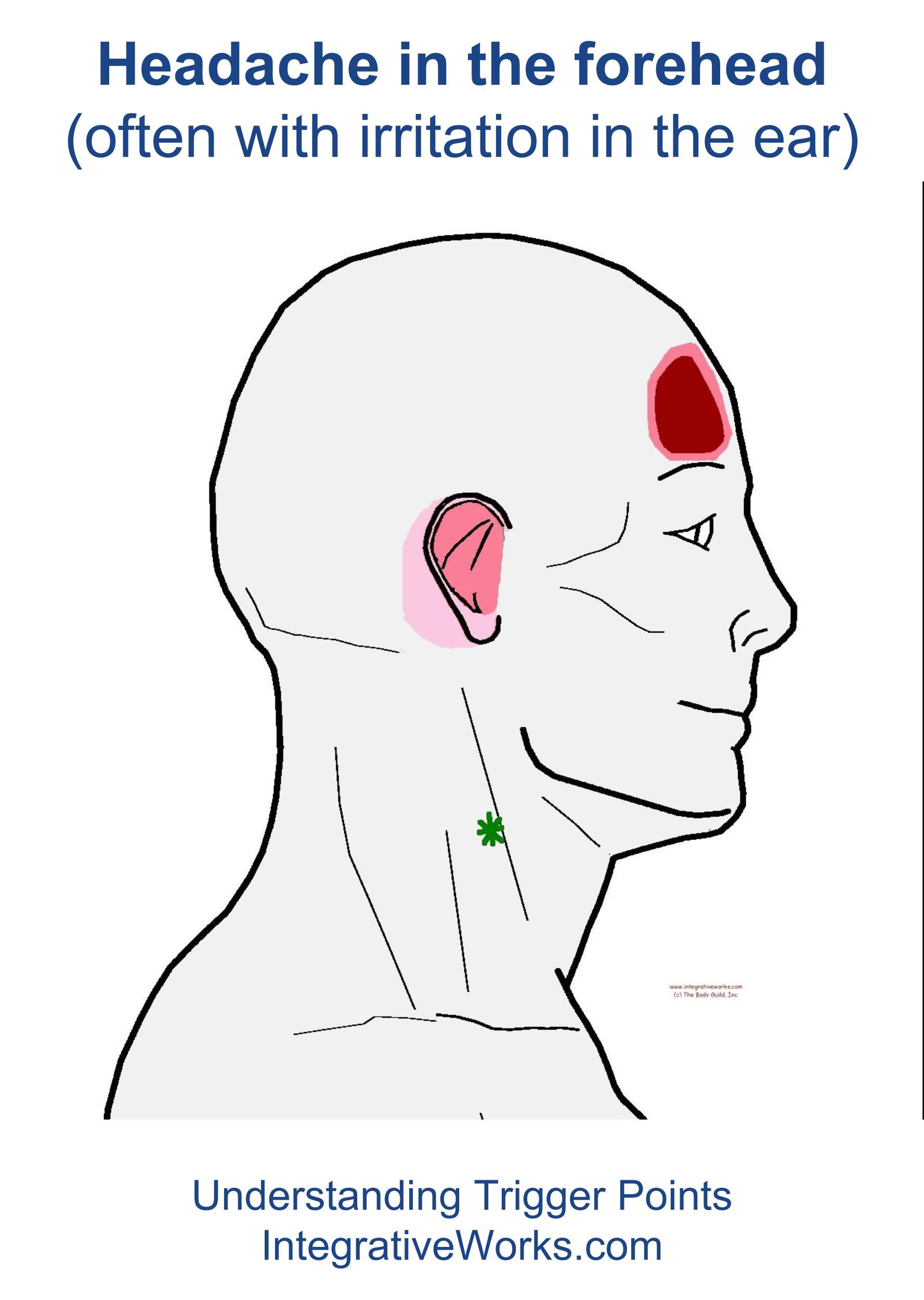 Trigger Points Headache In The Forehead Integrative Works