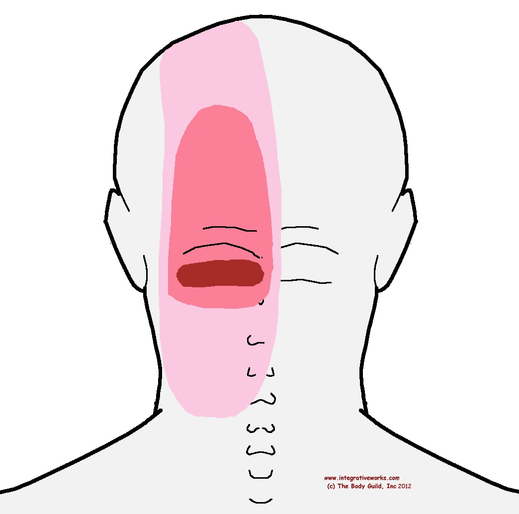 pin-on-headache-trigger-point-pain