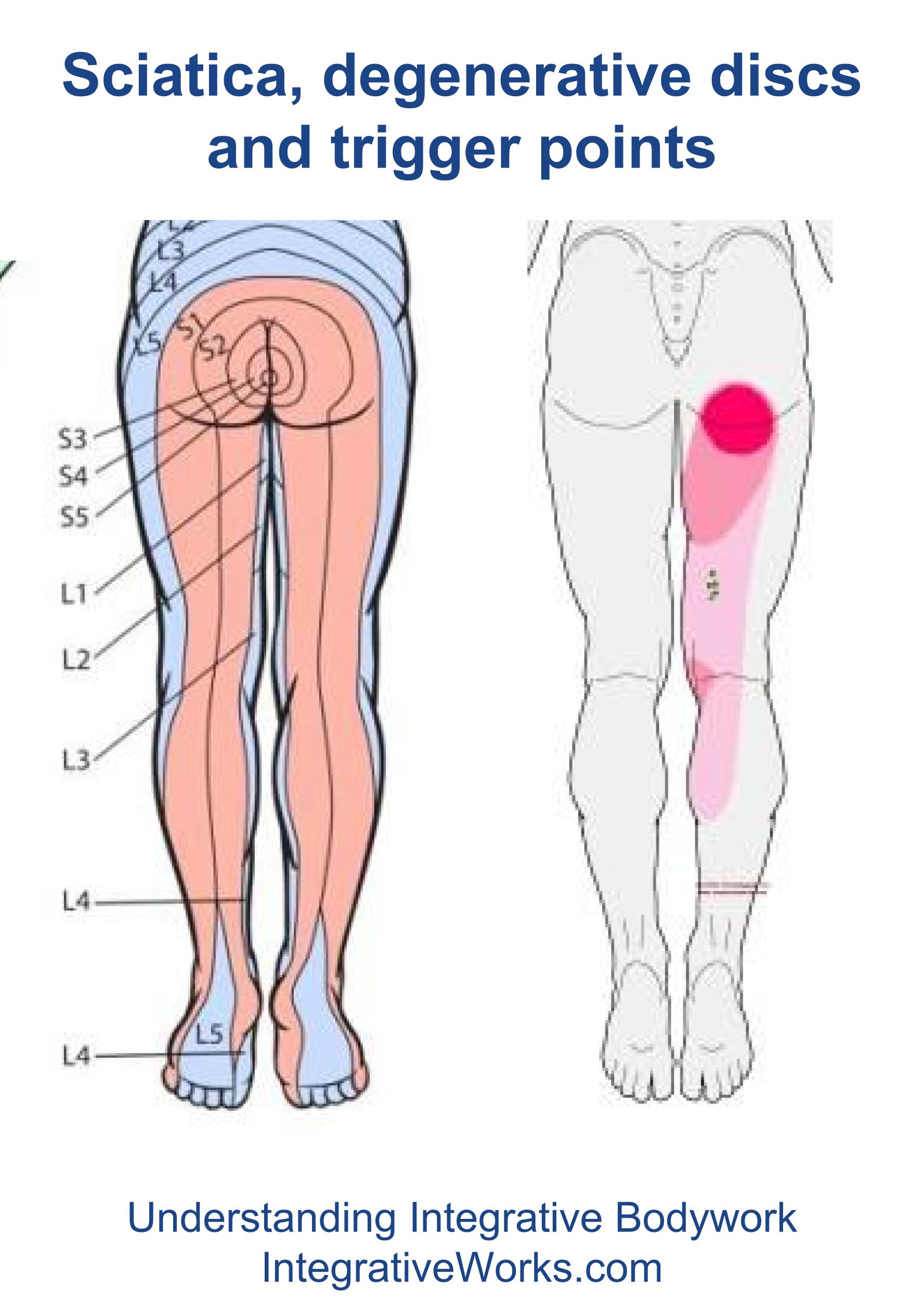 Sciatica Degenerative Discs And Trigger Points Integrative Works