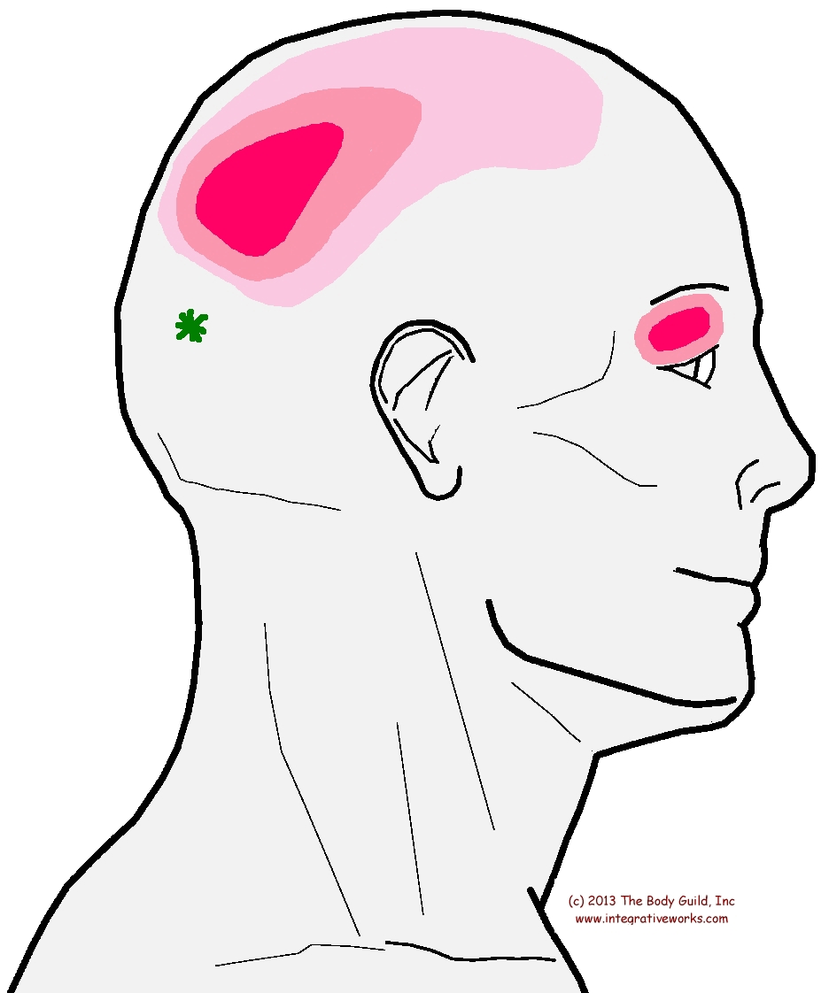 Trigger Points Headache With Eye Pain Integrative Works