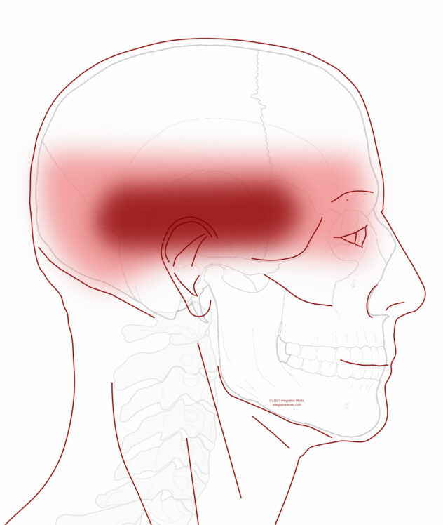 Headache All Over Or In A Band Around The Head - Integrative Works