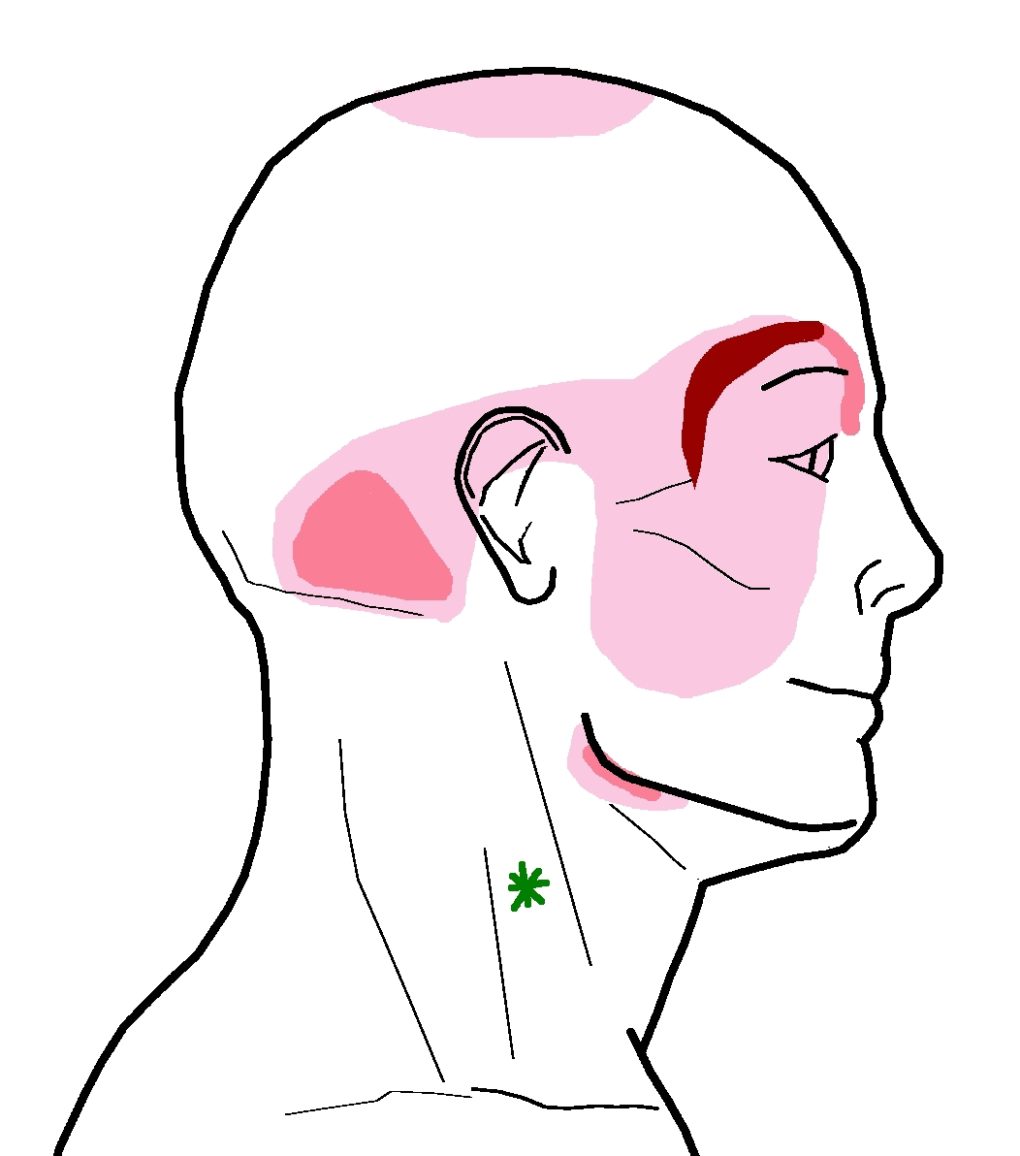 sternocleidomastoid trigger point pattern with headache around the temple