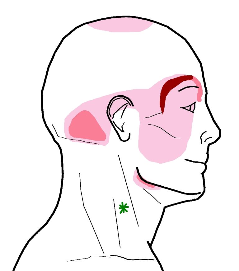 Headache Around The Eyebrow - Integrative Works