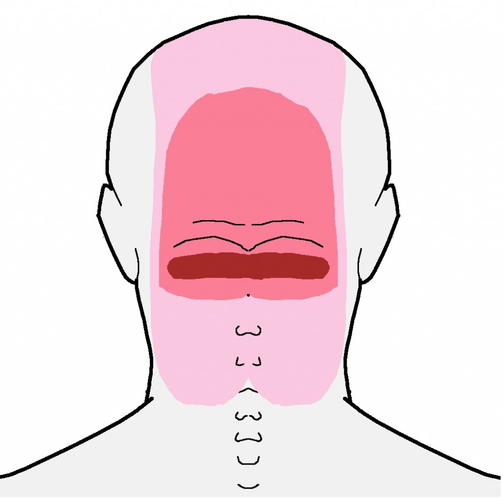 headache-at-the-base-of-the-head-integrative-works