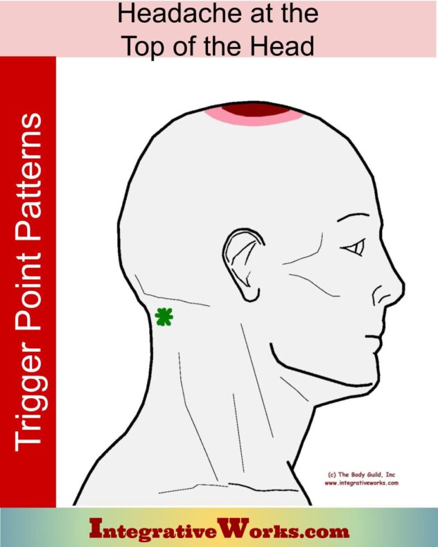 trigger-point-patterns-headaches-cervicogenic-integrative-works