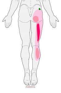 Referral pattern of the Gluteus Minimus