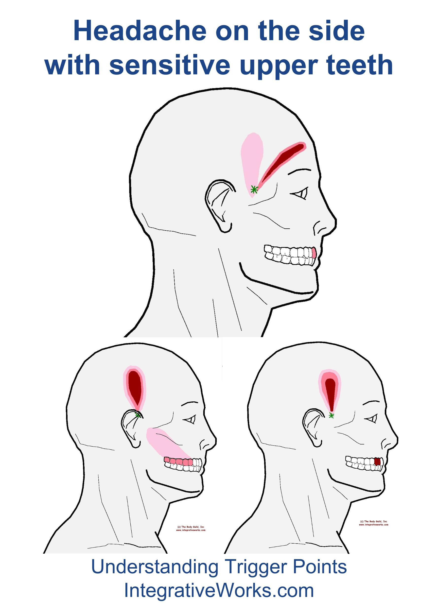 headache-with-sensitive-upper-teeth-integrative-works