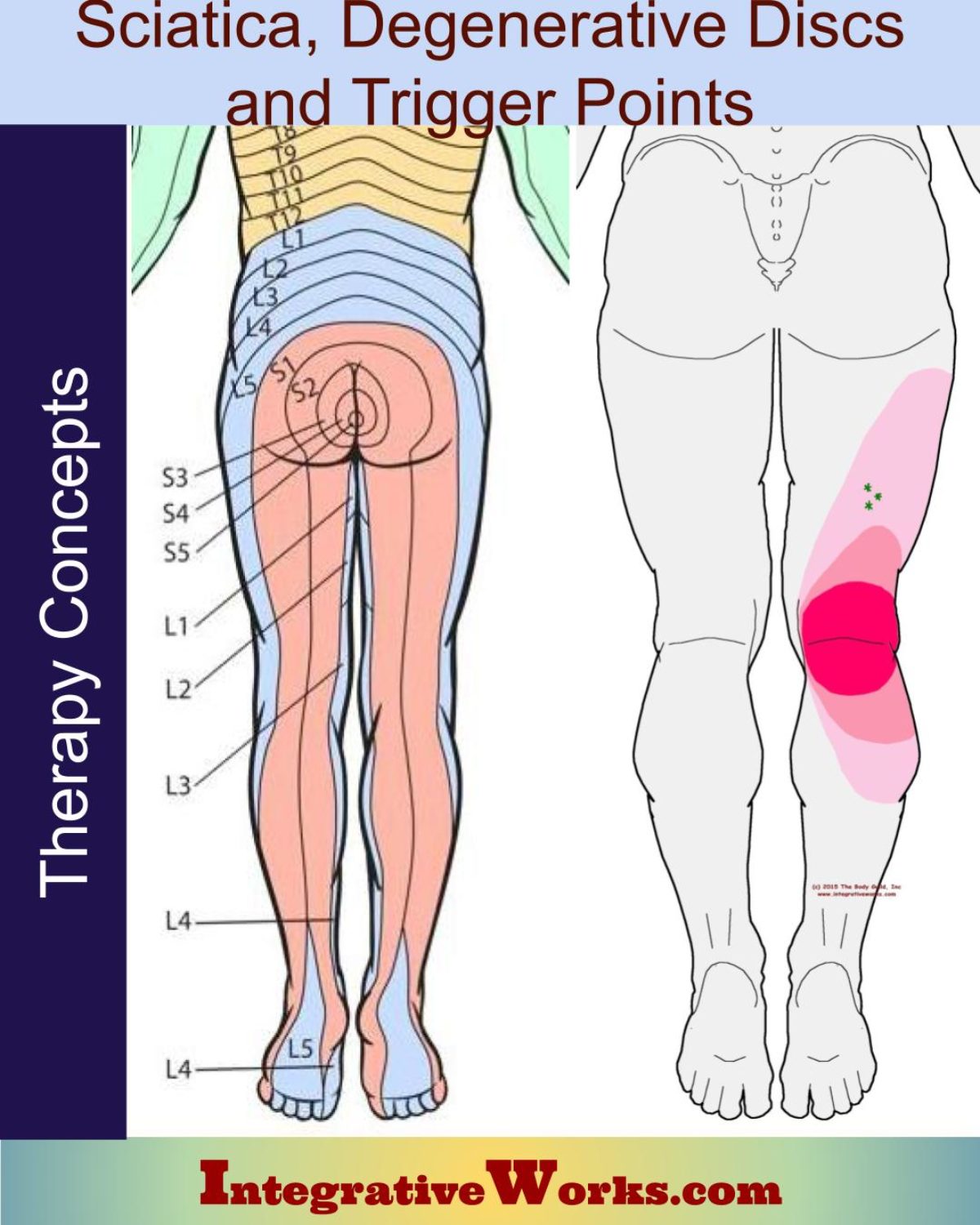 Sciatic Pain - Trigger Point Release, Low Back pain, Sciatic Pain, Sciatica  and more