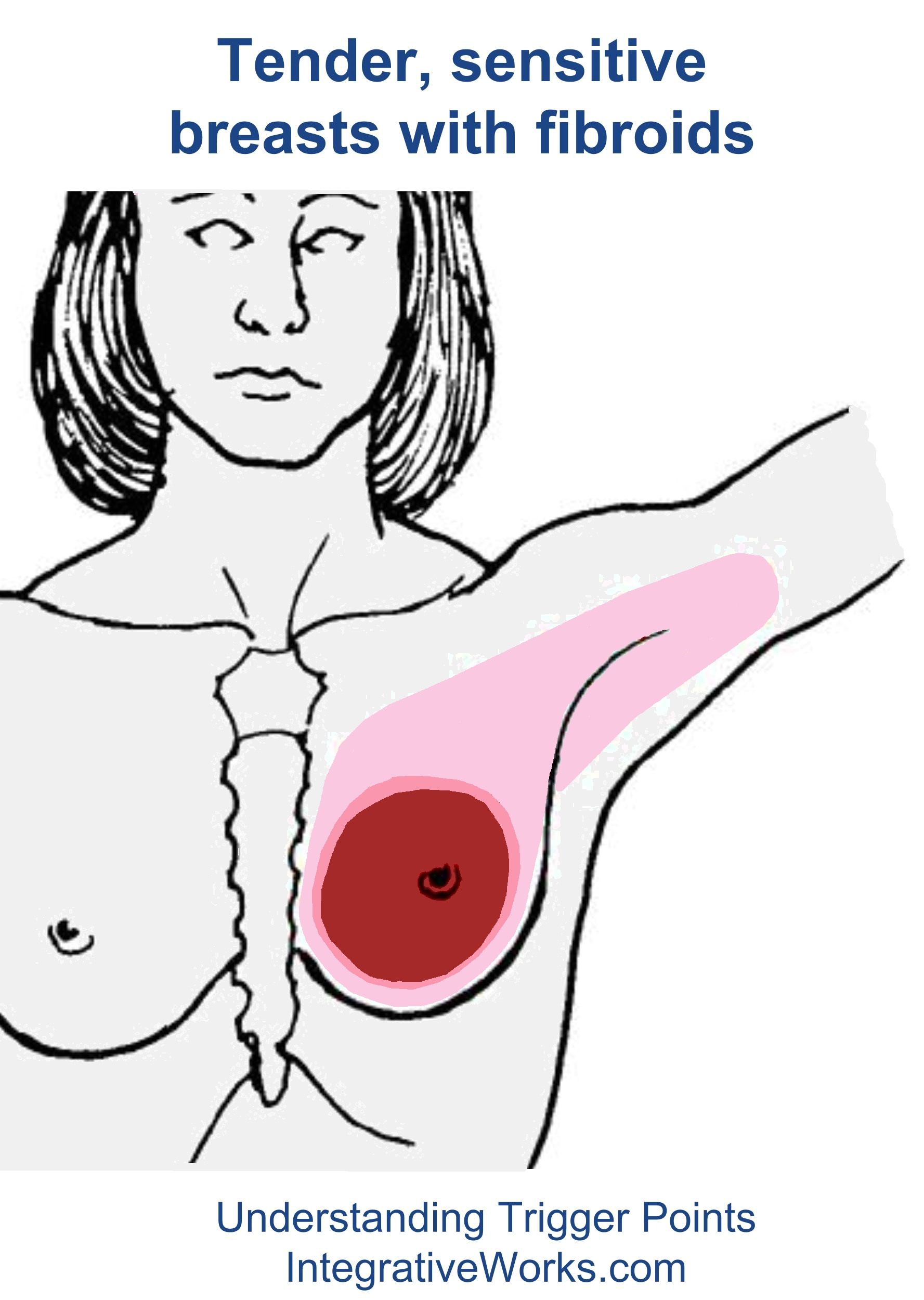 fi-tender-sensitive-breasts-with-fibroids