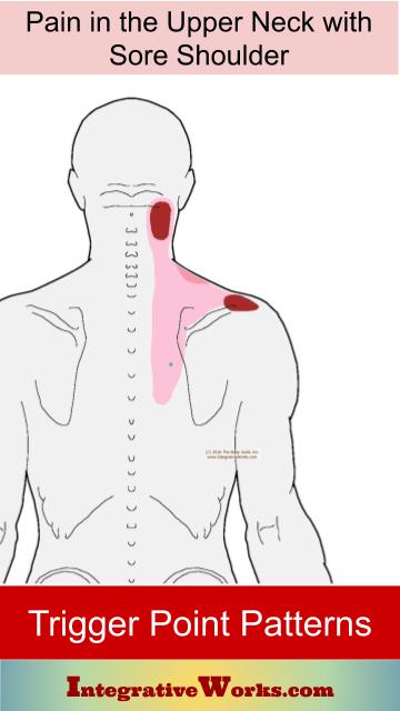 Neck Pain with Sore Shoulder - Trigger Points | Integrative Works