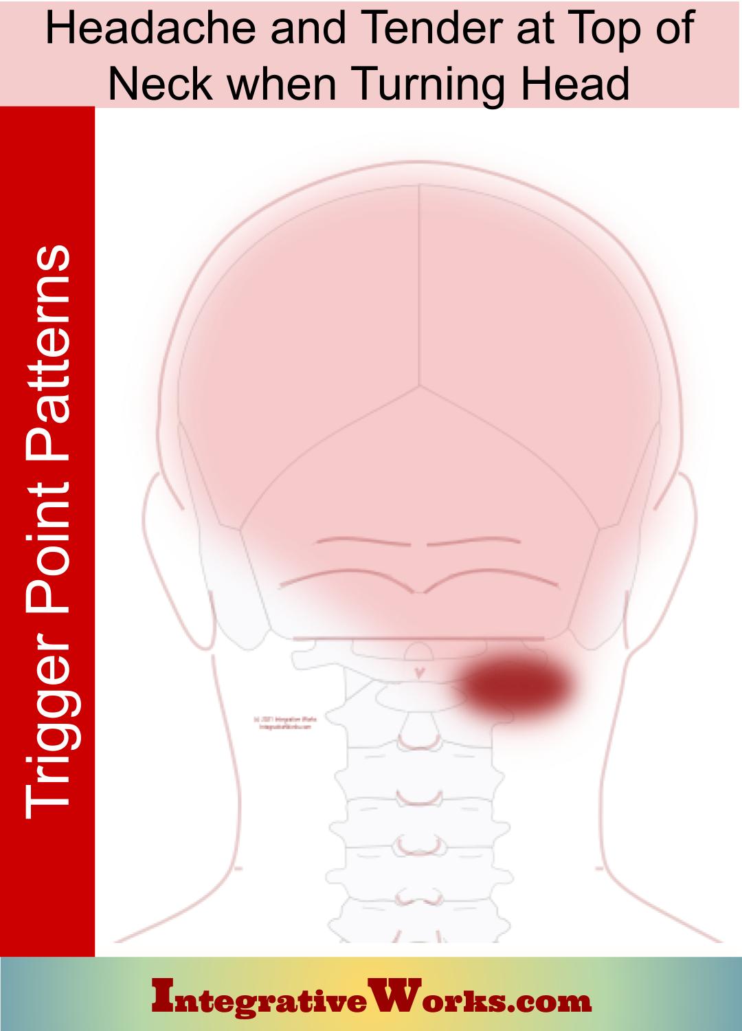 Headache with Tender Top of Neck While Turning