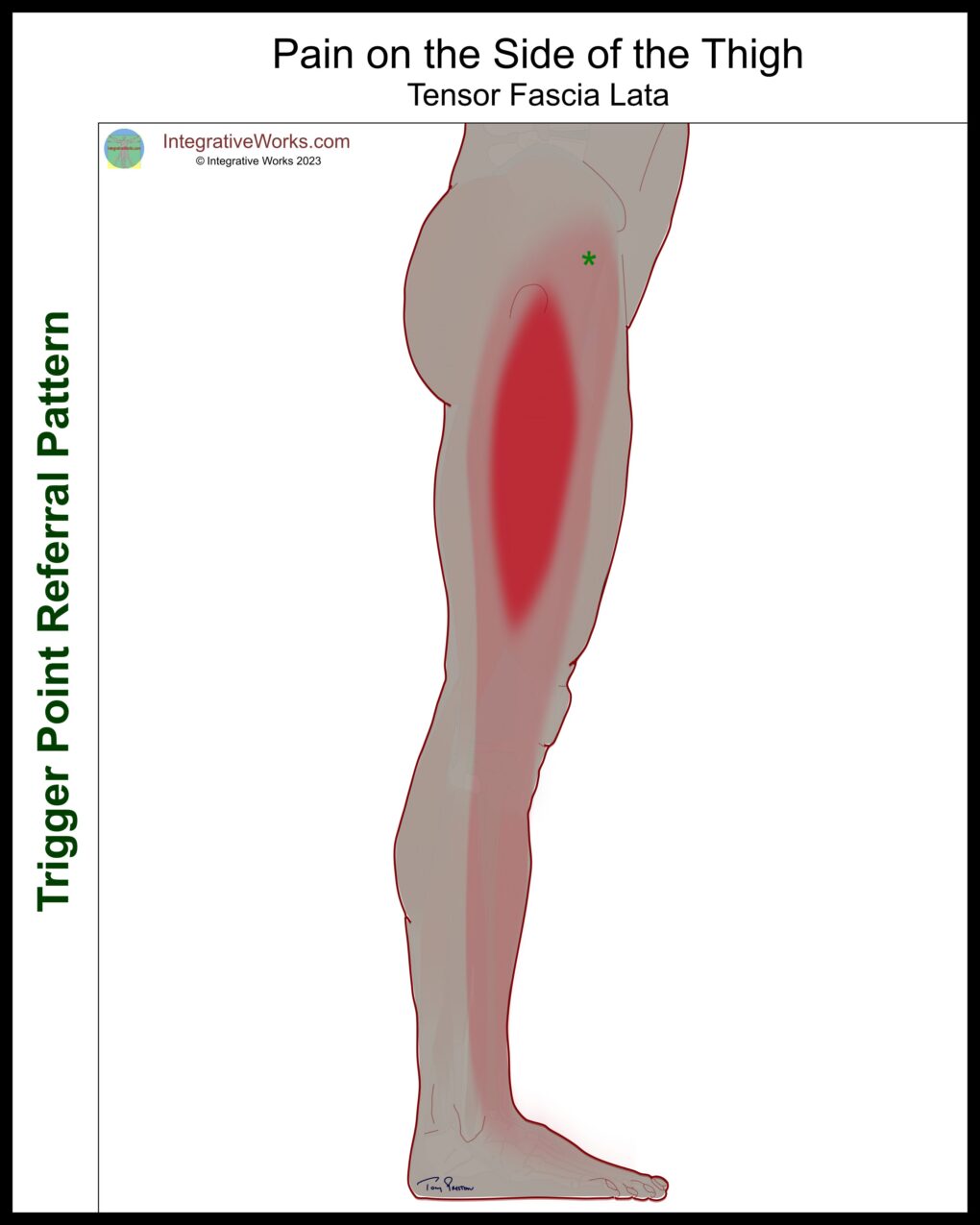 lateral - thigh - tensor fascai lata - referral