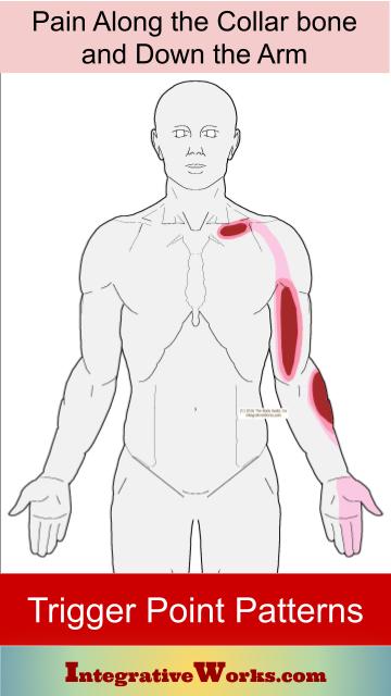 Pain Along The Biceps Maybe Collar Bone And Forearm Integrative Works