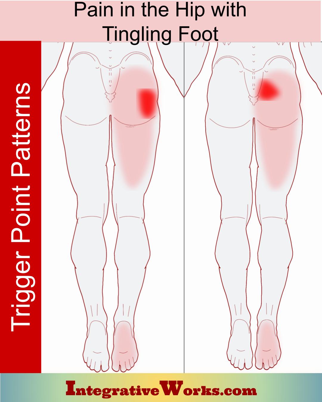 Hip Pain with Tingling Bottom of Foot