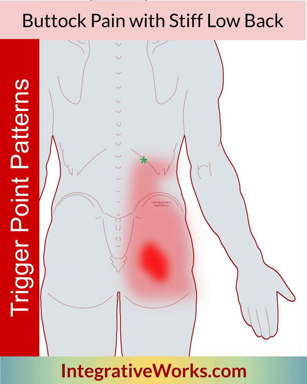 Buttock Pain with Stiff Low Back