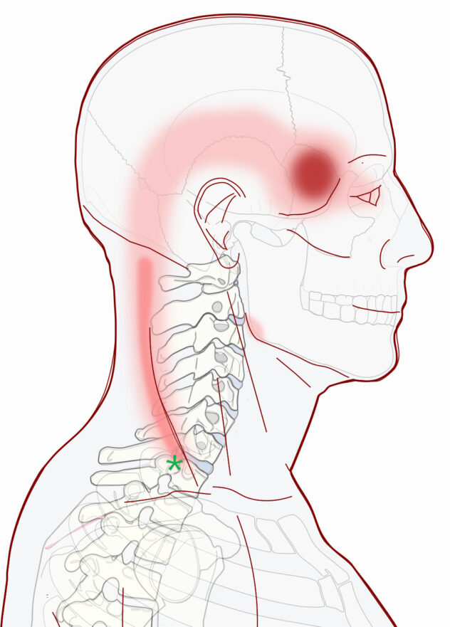 Headache At Your Temple with Stiff Neck - Integrative Works