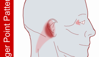 Pain Behind the Ear with Tension Down the Neck