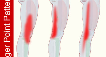 Pain Alongside of Thigh when Walking or Sleeping