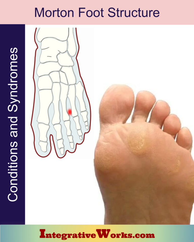 Morton's Foot Structure - Integrative Works