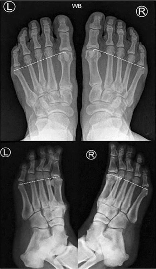 Morton's Foot Structure - Integrative Works