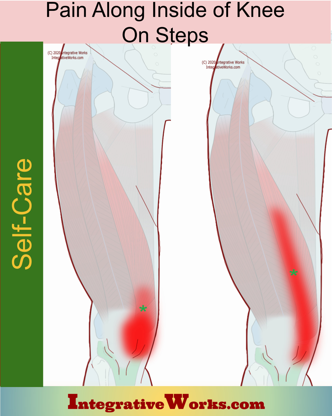 Self-Care - Pain Along Inside of Knee on Steps - Integrative Works