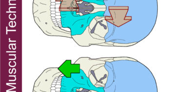 Structural Twist and Distraction of Frontal-Maxilla