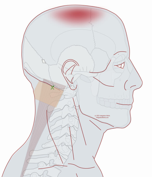 Self Care - Headache on the Top of Your Head - Integrative Works