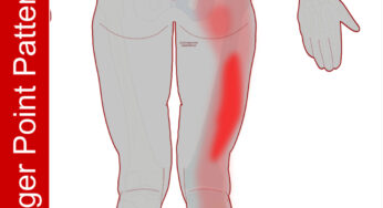Trigger Points and The Cramping Hamstring
