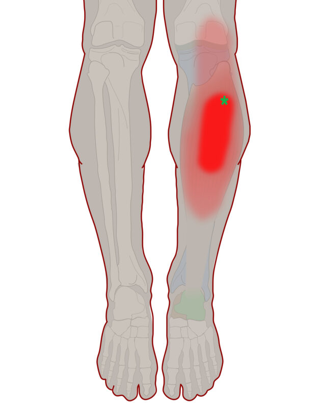 Pain Center of the Calf Integrative Works