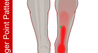 Painful Heel when Running or Sleeping