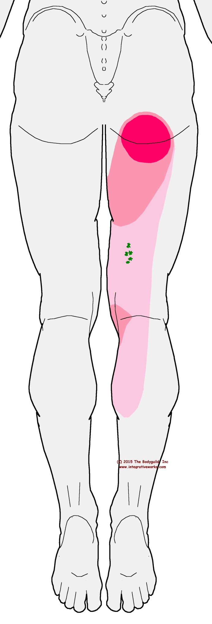Sciatica, Degenerative Discs and Trigger Points - Integrative Works